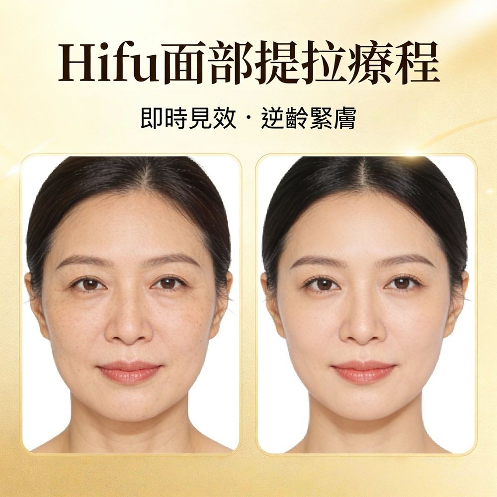 Hifu 面部提拉療程優惠劵 (體驗價 - 60分鐘) -一次